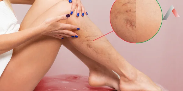 Derin Ven Trombozu (DVT) Nedir ?